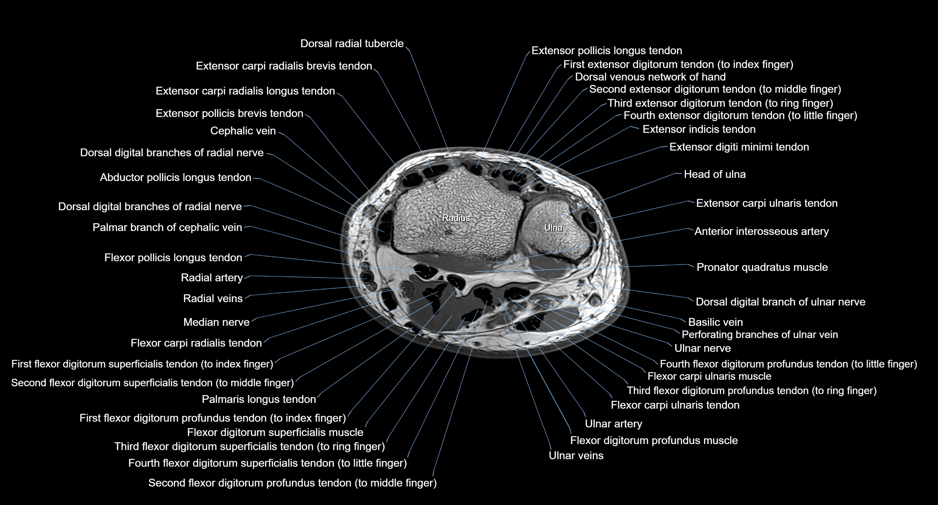 MRI wrist axial cross sectional anatomy 3T radiology  image-img-00001-00028.webp